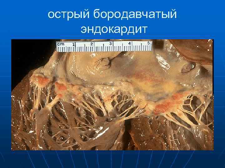 острый бородавчатый эндокардит 