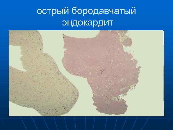 острый бородавчатый эндокардит 