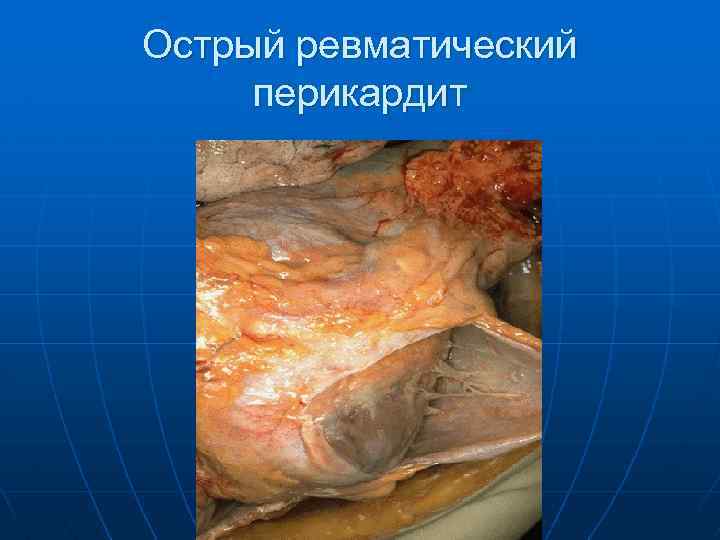 Острый ревматический перикардит 