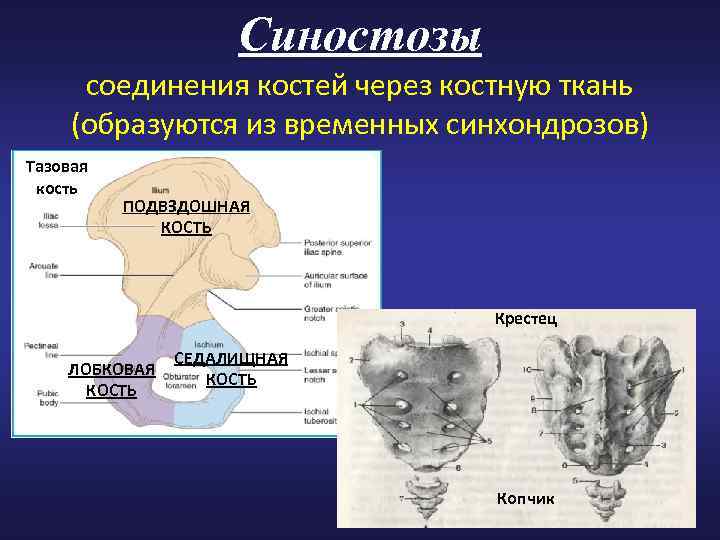 Синостозы соединения костей через костную ткань (образуются из временных синхондрозов) Тазовая кость ПОДВЗДОШНАЯ КОСТЬ