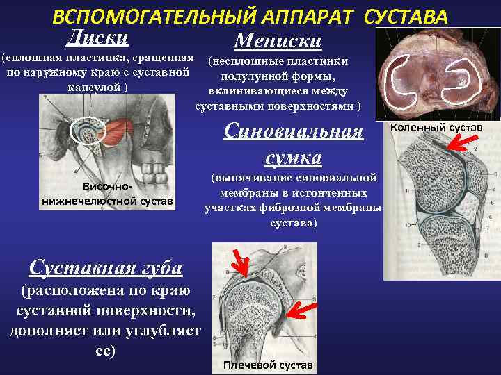 ВСПОМОГАТЕЛЬНЫЙ АППАРАТ СУСТАВА Диски Мениски (сплошная пластинка, сращенная по наружному краю с суставной капсулой