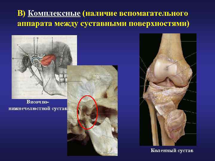 В) Комплексные (наличие вспомагательного аппарата между суставными поверхностями) Височнонижнечелюстной сустав Коленный сустав 