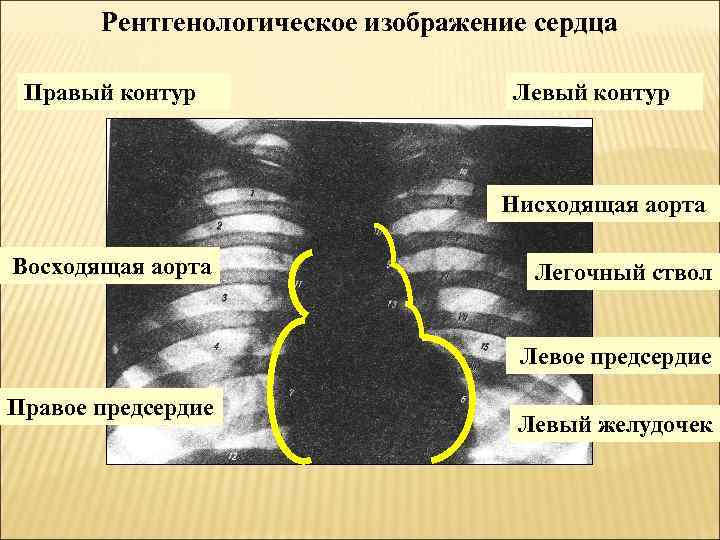 Рентгенологическое изображение сердца Правый контур Левый контур Нисходящая аорта Восходящая аорта Легочный ствол Левое
