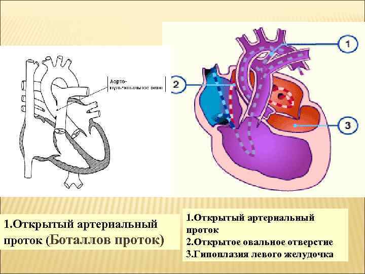 1. Открытый артериальный проток (Боталлов проток) 1. Открытый артериальный проток 2. Открытое овальное отверстие