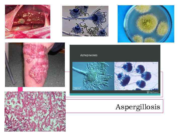 Aspergillosis 