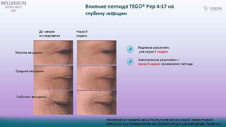 Влияние пептида TEGO® Pep 4 -17 на глубину морщин До начала исследования Мелкие морщины