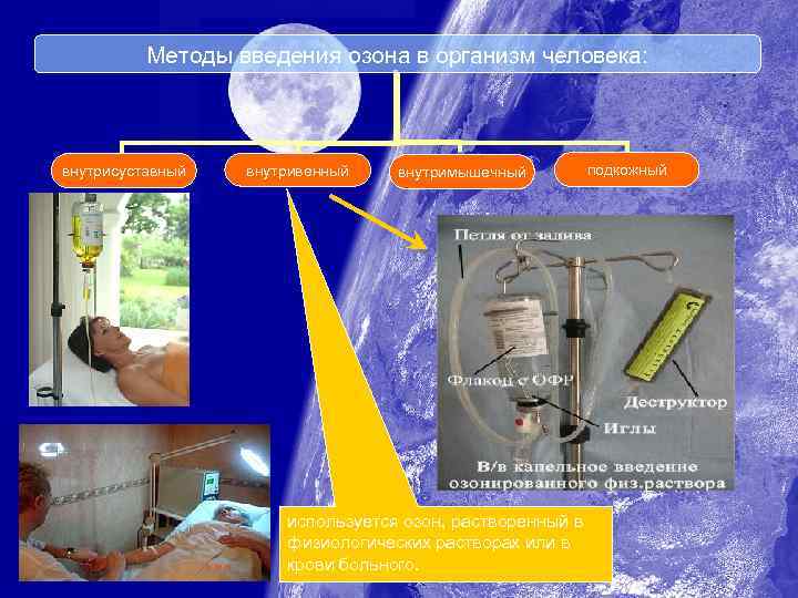 Методы введения озона в организм человека: внутрисуставный внутривенный внутримышечный используется озон, растворенный в физиологических