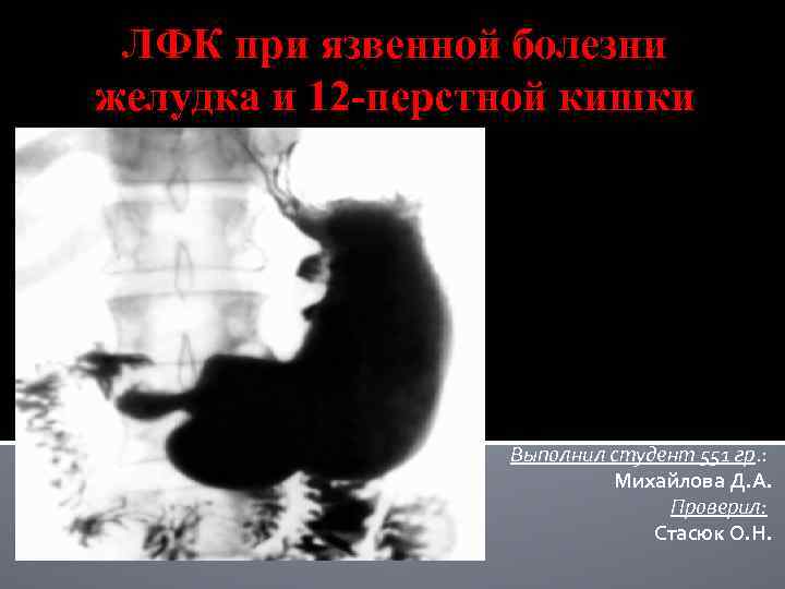 ЛФК при язвенной болезни желудка и 12 -перстной кишки Выполнил студент 551 гр. :