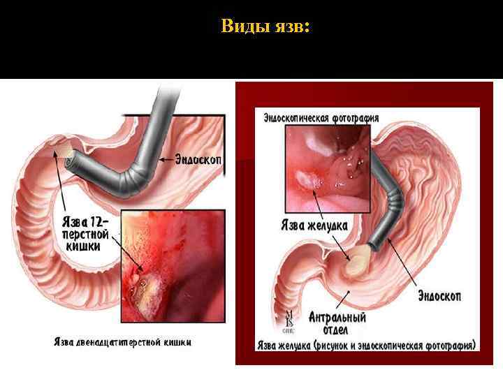 Виды язв: 