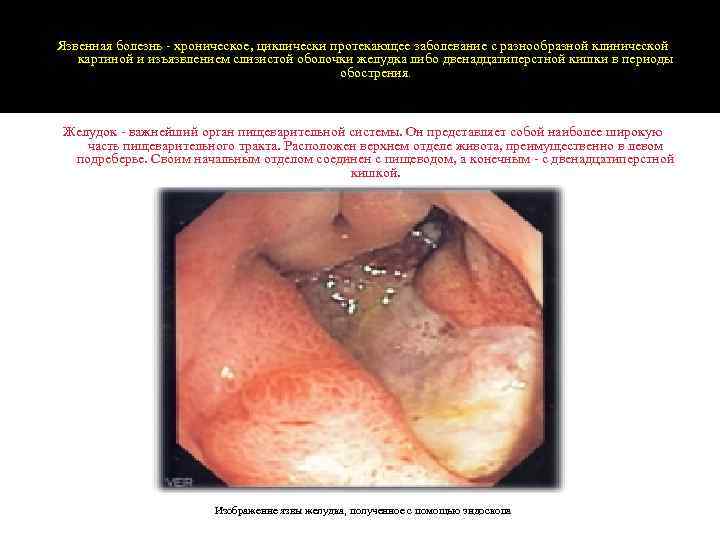 Язвенная болезнь - хроническое, циклически протекающее заболевание с разнообразной клинической картиной и изъязвлением слизистой