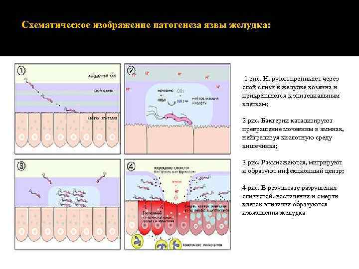 Схематическое изображение патогенеза язвы желудка: 1 рис. H. pylori проникает через слой слизи в