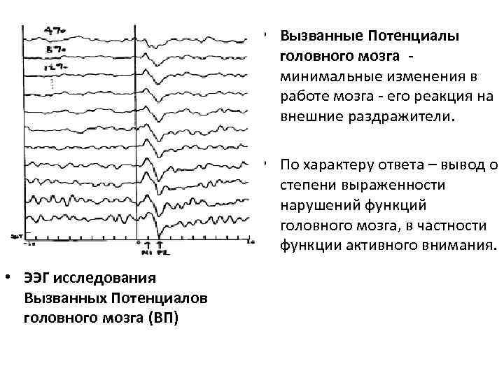  • Вызванные Потенциалы головного мозга минимальные изменения в работе мозга - его реакция