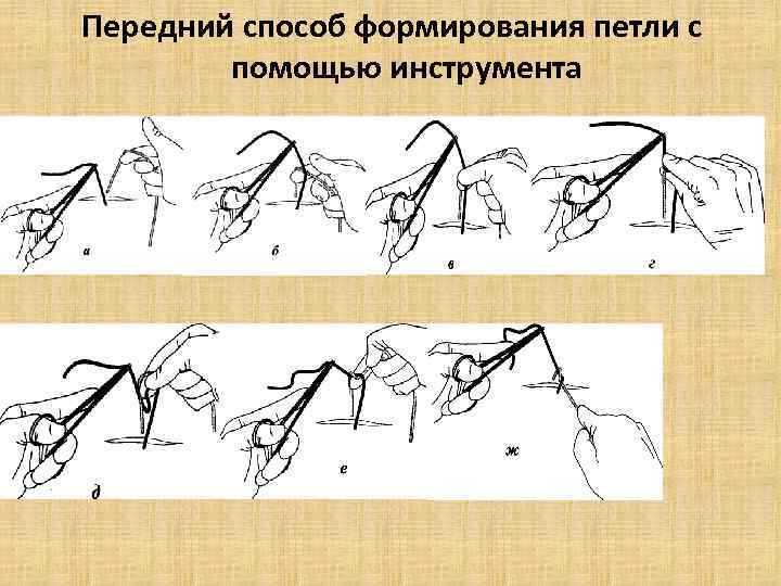 Передний способ формирования петли с помощью инструмента 