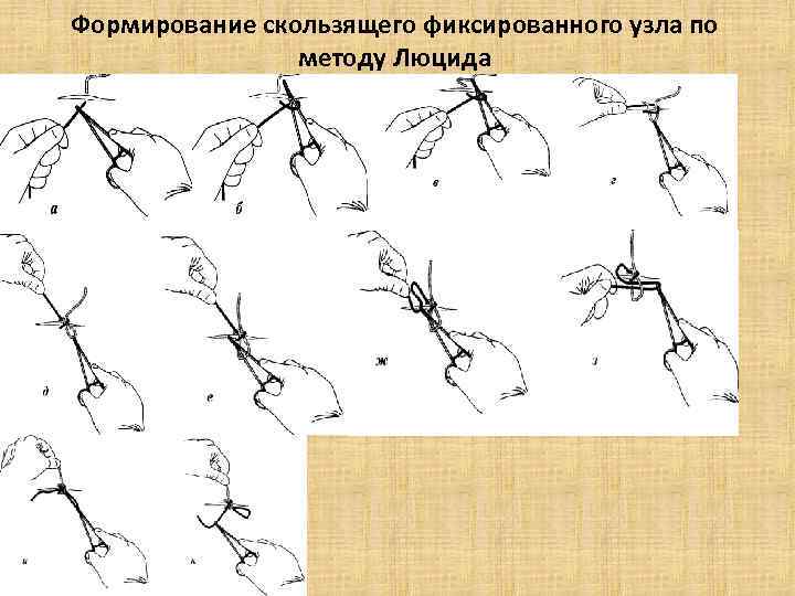 Формирование скользящего фиксированного узла по методу Люцида 