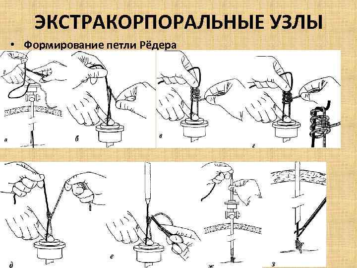 ЭКСТРАКОРПОРАЛЬНЫЕ УЗЛЫ • Формирование петли Рёдера 