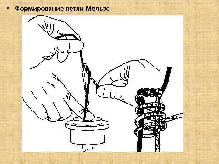  • Формирование петли Мельзе 