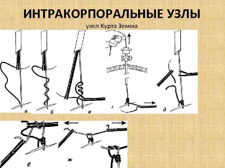 ИНТРАКОРПОРАЛЬНЫЕ УЗЛЫ узел Курта Земма 