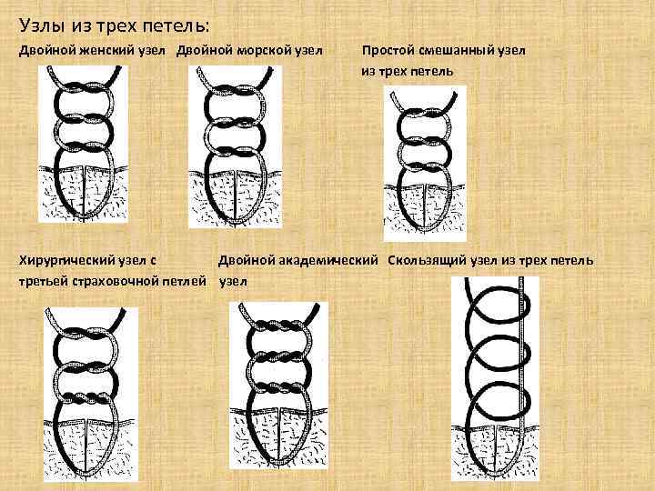 Три узелка. Морской хирургический узел. Простой морской и хирургический узлы. Женский хирургический узел. Морской узел топографическая анатомия.