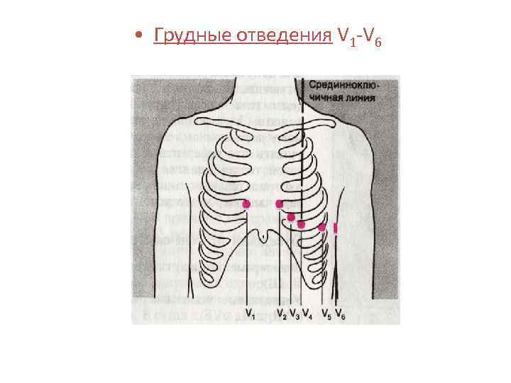  • Грудные отведения V 1 -V 6 