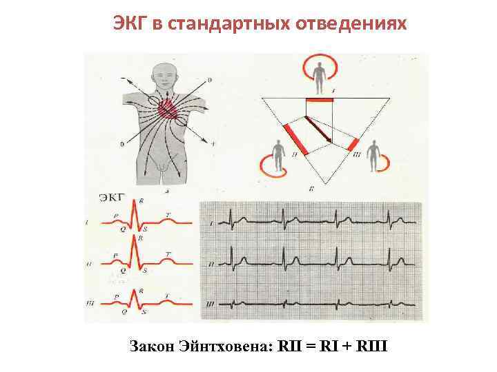 ЭКГ в стандартных отведениях Закон Эйнтховена: RII = RI + RIII 