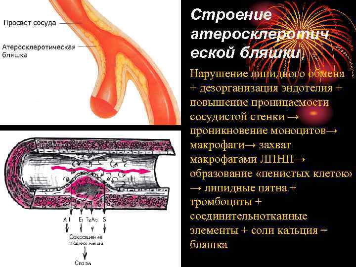 Строение атеросклеротич еской бляшки Нарушение липидного обмена + дезорганизация эндотелия + повышение проницаемости сосудистой