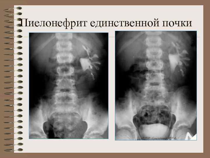 Аномалии развития почки картинки