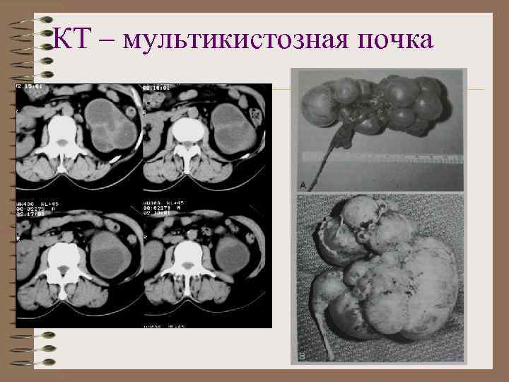 КТ – мультикистозная почка 