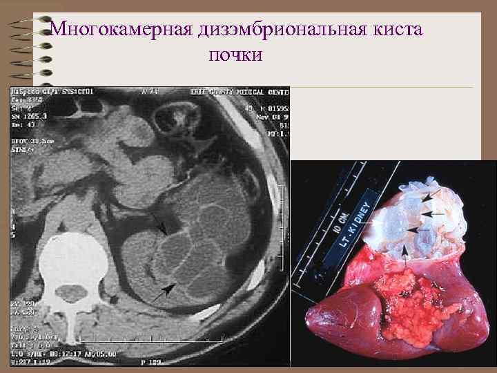 Многокамерная дизэмбриональная киста почки 