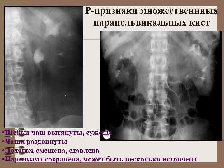 Парапельвикальные кисты почек