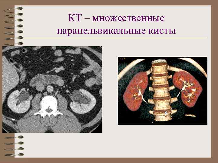 Парапельвикальная киста левой почки