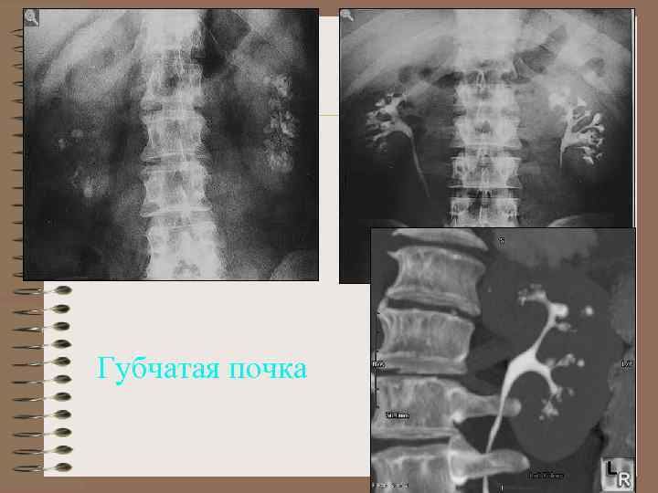 Губчатая почка 