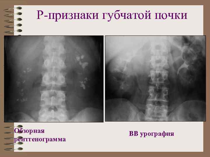 Р-признаки губчатой почки Обзорная рентгенограмма ВВ урография 