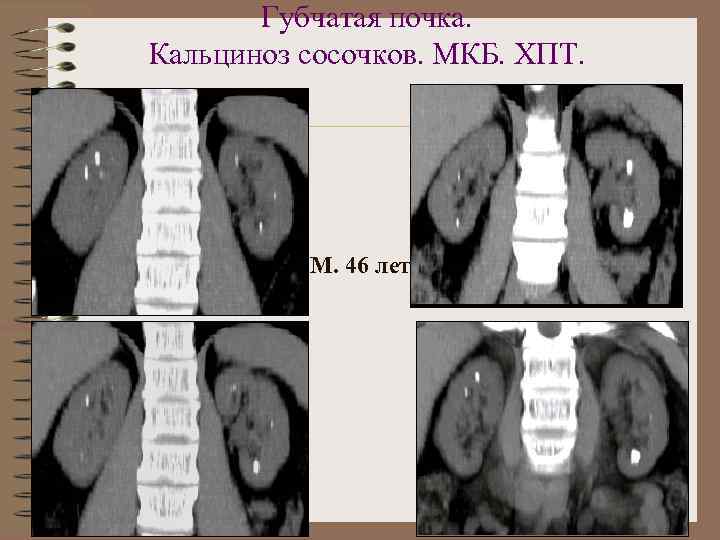 Губчатая почка. Кальциноз сосочков. МКБ. ХПТ. М. 46 лет 