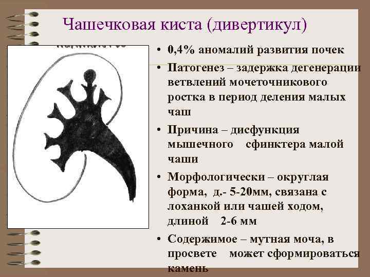 Типы кисты почек. Дивертикул чашечки почки. Дивертикул чашечки почки кт. Дивертикул верхней чашечки почки. Дивертикул чашечки левой почки.