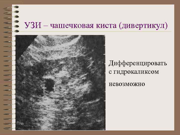 УЗИ – чашечковая киста (дивертикул) Дифференцировать с гидрокаликсом невозможно 