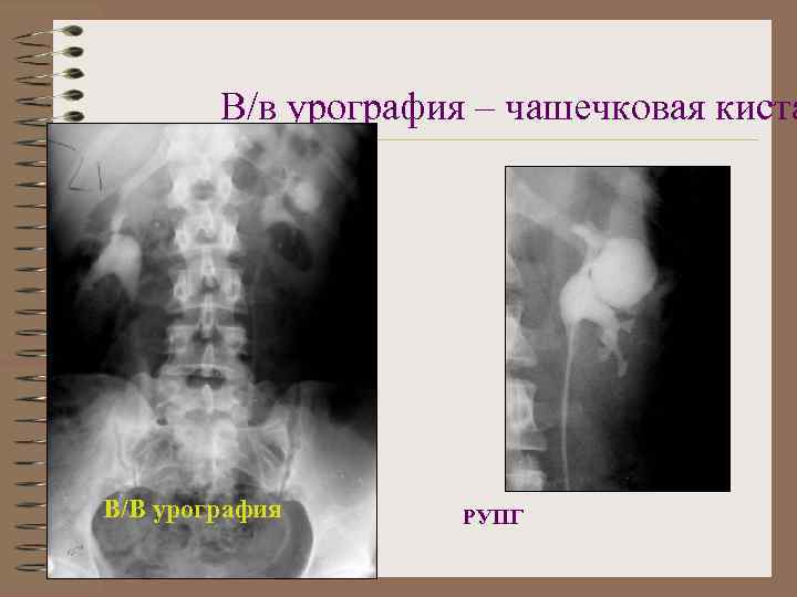 В/в урография – чашечковая киста В/В урография РУПГ 