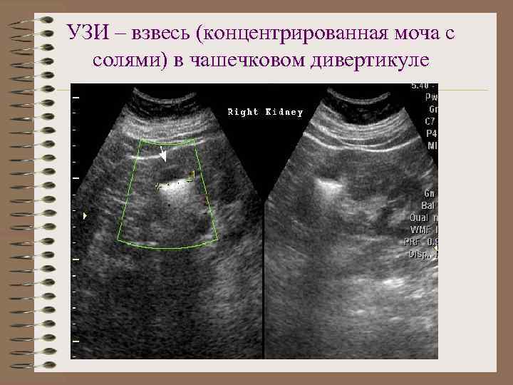 УЗИ – взвесь (концентрированная моча с солями) в чашечковом дивертикуле 