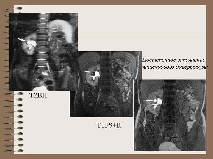 Постепенное заполнение чашечкового дивертикула Т 2 ВИ Т 1 FS+К 