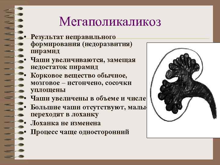 Мегаполикаликоз • Результат неправильного формирования (недоразвития) пирамид • Чаши увеличиваются, замещая недостаток пирамид •