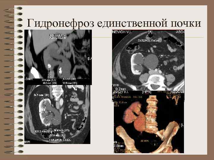 Аномалии развития почки картинки