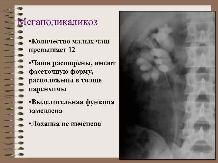 Мегаполикаликоз • Количество малых чаш превышает 12 • Чаши расширены, имеют фасеточную форму, расположены