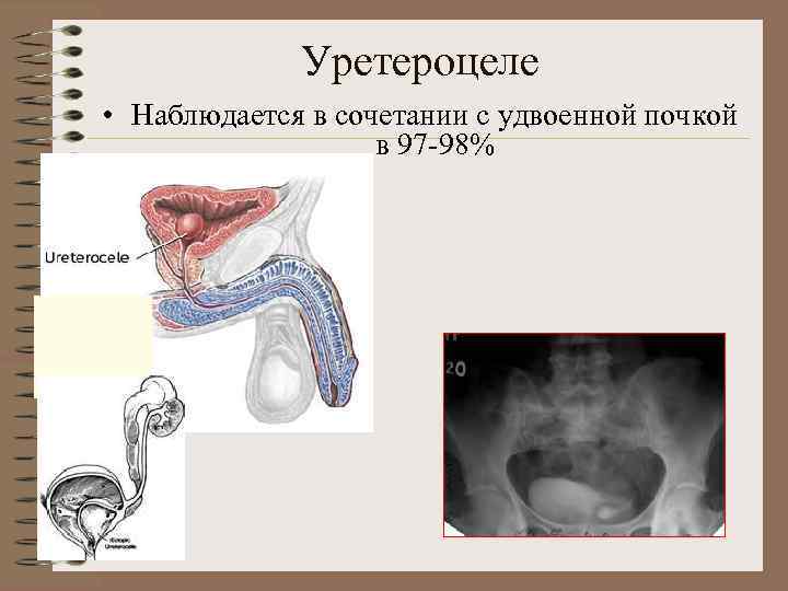 Уретроцеле у женщин фото