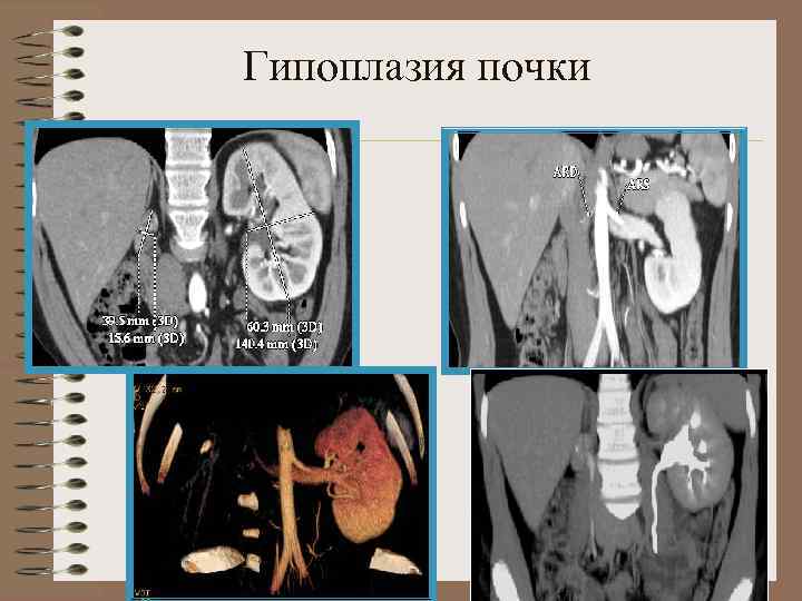 Аномалии развития почки картинки