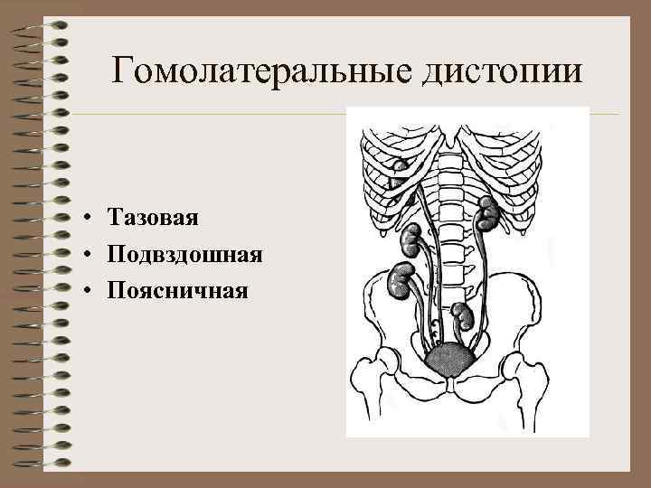 Нефроптоз дистопия. Подвздошная дистопия почки. Поясничная дистопия почки рентген. Гомолатеральная дистопия почки.