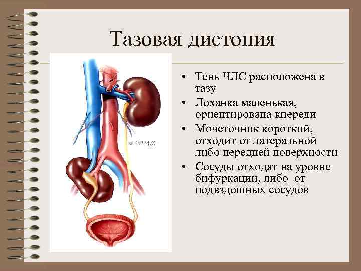 Аномалии мочеточников презентация