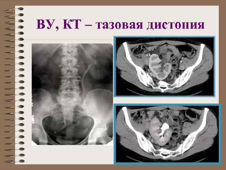 Аномалии развития почки картинки