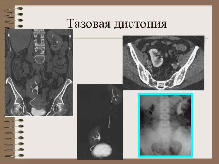 Аномалии развития почки картинки