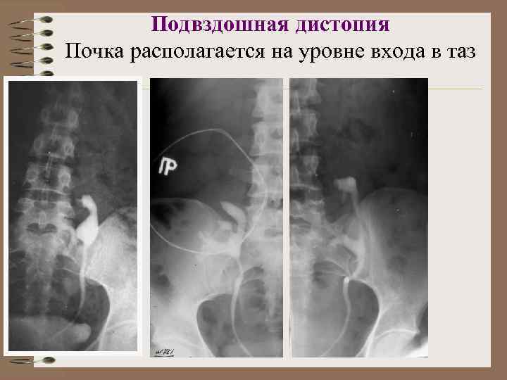 Дистопия почки. Тазовая дистопия почки рентген. Перекрестная дистопия почки. Торакальная дистопия почки. Подвздошная дистопия почки рентген.