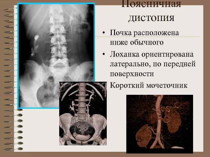 Аномалии развития почки картинки