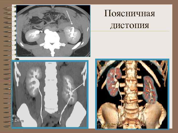 Нефроптоз дистопия